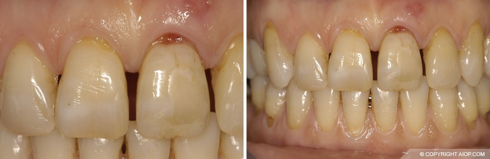 caso-Sostituzione-di-un-incisivo-centrale-superiore-01